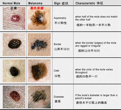 痣 顏色|黑色素瘤警告標誌和圖像